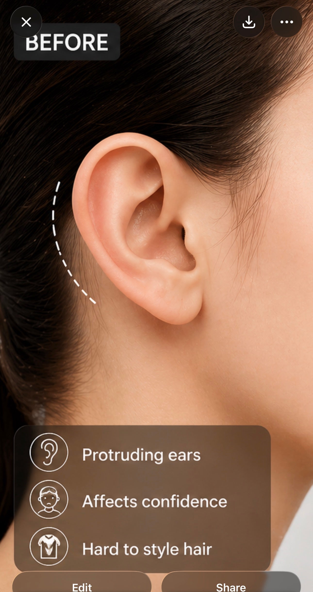 Ear Corrector