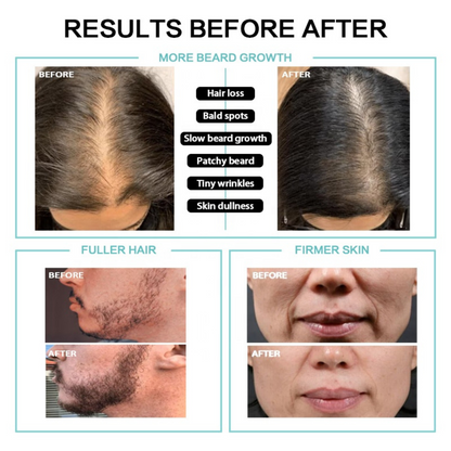Derma Roller