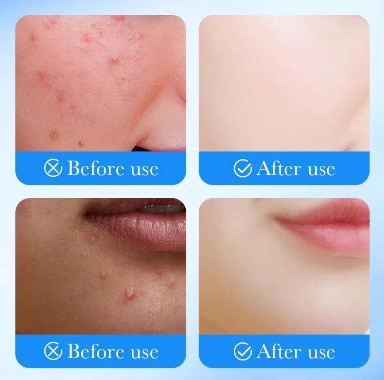 Pimple Patches for Acne Removal & Healing with Salicylic Acid – 36 Patches